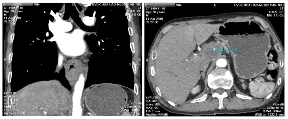 k thực quản - 4.png